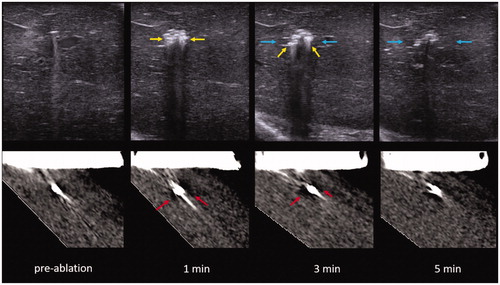 Figure 5. US (top) vs. CT (bottom) intra-procedure images of RF ablation at each point of image recording in the experiment. Note how the zone of visible gas is most pronounced at 1 and 3 min (yellow arrow) with minimal visible gas 5 min into the ablation. Similarly, gas is most notable at 1 and 3 min on CT (red arrows) with more dissipated gas at 5 min. A hypoechoic zone is noted at 3 and 5 min on the ultrasound (blue arrows), while the hypodense zone at CT is difficult to visualize.