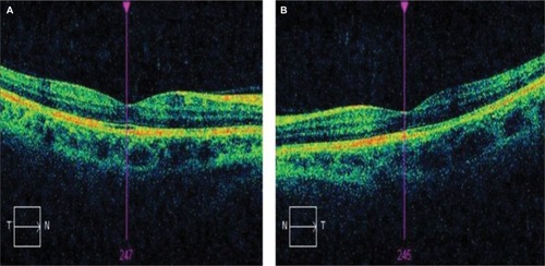 Figure 2 OCT macular images of right (A) and left (B) eyes after cessation of topiramate treatment.