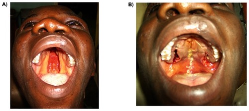 Figure 6 Repair of a complete cleft of the palate using von Langenbeck’s technique: A) preoperative appearance; B) postoperative appearance.