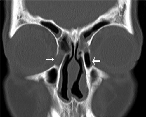 Figure 3 Coronal image illustrating an opacified (small arrow) and a fully aerated (large arrow) lacrimal sac.