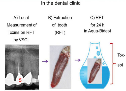 Figure 2 In the dental clinic: From left to right: (A) Local measurement of toxins in the sulcus of the RFT with the VSCI (here, grade 5); (B) extraction of the RFT; (C) place the RFT in Aqua-Bidest for 24 hours at room temperature.