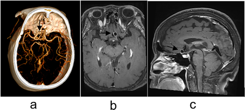Figure 3 Female patient, 66 years old. (a–c) were images of CTA, VR, and HI-VWI respectively, which could show the aneurysm of the cavernous segment of the left internal carotid artery, and the tumor wall was significantly enhanced after enhancement. (a) is VR image of CT and the black arrow shows an aneurysm in the cavernous segment of the left internal carotid artery; (b and c) are high-resolution MRI cross-sectional and sagittal images and the black arrows show the presence of enhancement in the aneurysm wall.