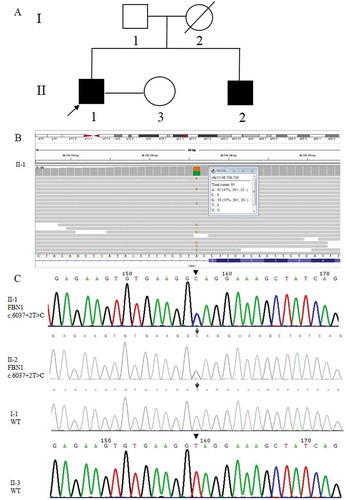 Figure 1. Causative variant detection in this family. (A) Pedigree of the MFS family reported in this study. Squares and circles indicate males and females, respectively. The black symbols II-1 (the proband) and II-2 (his younger brother) represent the male patients who suffered from MFS. The blank symbols show I-1 (his father) and II-3 (his wife) were unaffected and I-2 (his mother died of heart disease without specific diagnosis). (B) The pathogenic mutation site (FBN1: NM_000138; chr15:48,736,736 c.6037 + 2 T > C) of II-1 (the proband) detected by NGS. The figure provides the result of the antisense chain reads. (C) Sanger sequencing results of the FBN1 gene in the MFS family. II-1 and II-2 carried the FBN1 gene mutation c.6037 + 2 T > C, while I-1 and II-3 were wild-type (WT)