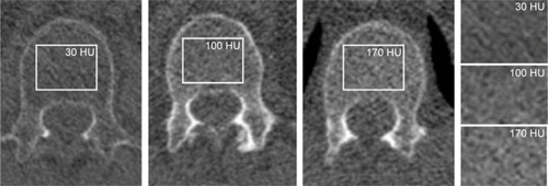 Figure 3 CT-derived bone density measurements of the spine.