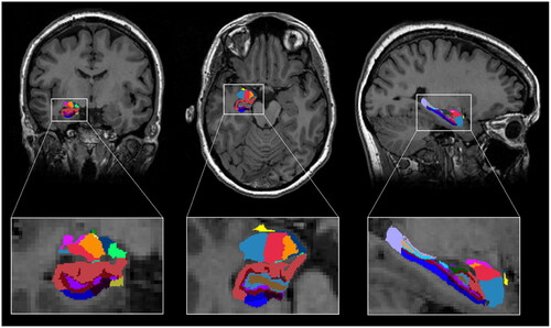 Figure 1. Segmentation of hippocampal subfields and amygdala nuclei. T1-weighted scan with segmentations from a representative subject using the longitudinal stream. Results are displayed in coronal-, axial- and sagittal view and radiological convention (right = left).