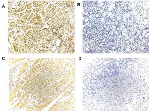 Figure 2 IHC staining of THBS1 (magnification, x200). (A) High expression of THBS1 in GC tissues. (B) Low expression of THBS1 in GC tissues. (C) High expression of THBS1 in adjacent normal tissues. (D) Low expression of THBS1 in adjacent normal tissues.