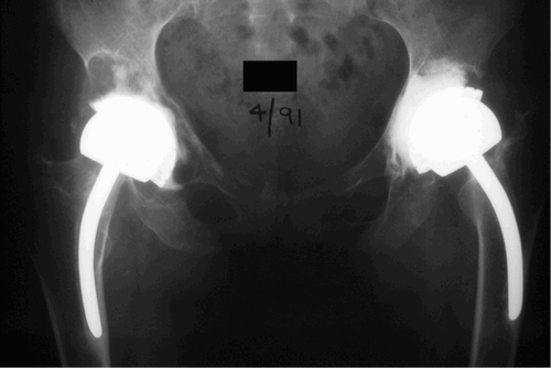 Figure 1B. 5 years later, the left hip was painful and the limb had shortened. Radiographs showed that the left femoral component had subsided and migrated into varus. The right hip was not painful, despite the extensive acetabular periprosthetic osteolysis.