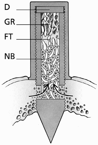 Figure 1. The bone conduction chamber. The chamber consists of two threaded half-cylinders held together by a cylindrical closed screw cap. There are ingrowth openings at the endosteal level. A 1 mm thick plate (D) was inserted into the cap to lower the ingrowth openings through the cortex. New bone (NB) and fibrous tissue (FT) are shown growing into the graft. Unremodeled graft (GR) can be seen at the top of the chamber. Modified from Jeppsson et al. (Citation2003).