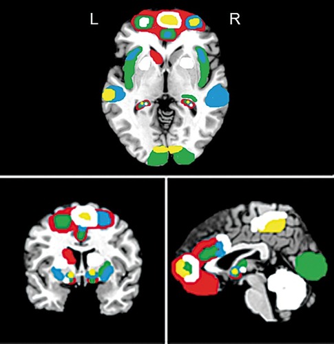 Figure 2. A schematic brain activation map demonstrating regional activation most altered by CBT in PTSD (red), PD (green), GAD (blue), SAD (yellow) and OCD (white). For demonstration purposes only and not accurate depiction of size of activation for each anxiety disorder. Colored regions represent areas of altered activation following a course of CBT. PTSD, post-traumatic stress disorder; PD, panic disorder; GAD, generalized anxiety disorder; SAD, social anxiety disorder; OCD, obsessive-compulsive disorder