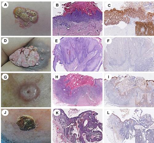 Figure 3 Clinical and histopathological appearances of Bowen (A, B; HE×10), verrucous carcinoma (D, E; HE×10), keratoacanthoma (G, H; HE×10) and acantholytic SCC (J, K; HE×10). HSP105 is highly expressed in Bowen, while shows a trend of lower expression in verrucous carcinoma, keratoacanthoma and acantholytic SCC (C, F, I, L; IHC×10).