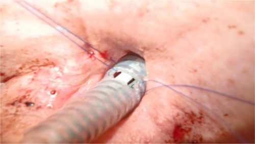 Figure 9 The anterior surface of FS has been cut already, and inside the FS a DLET and nasal jet-catheter are used for stabilization.