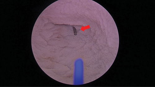 Figure 2. Live tracking of temperature changes via a type K thermocouple in the bladder dome during the ex vivo trials.