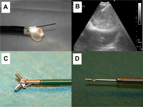 Figure 1 (A) Endobronchial ultrasound tip with the ultrasound balloon dilated with water for injection. The biopsy tip is out of the plastic protection probe. (B) Lymph node seen on endobronchial ultrasound, showing the biopsy tip inside the lymph node. (C) Biopsy forceps and (D) biopsy needle.