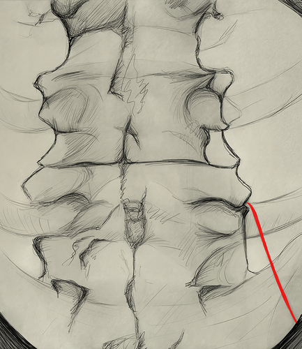 Figure 2 Antero-posterior view showing the cannula (red) crossing the ala of the sacrum and lying against the superior articular process of L5.