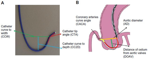 Figure 15 Optimum catheter selection by matching aortic sinus measurements with guide catheters available on the shelf in the catheterization laboratory.