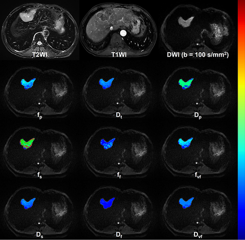 Figure 3 Representative MRI images including the T2WI, T1WI, DWI of b = 100 s/mm2 and bi-IVIM-derived parametric maps (fp, Dt and Dp) as well as tri-IVIM-derived parametric maps (fs, ff, fvf, Ds, Df and Dvf) of a patient with MVI-positive HCC.
