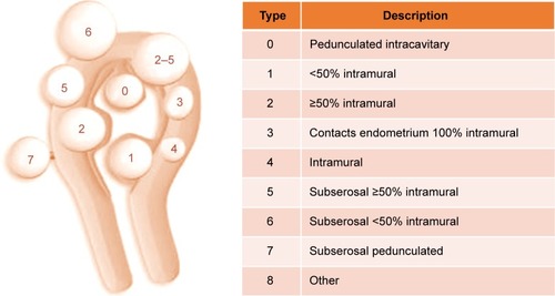 Figure 3 The International Federation of Gynecology and Obstetrics classification system for uterine fibroids.