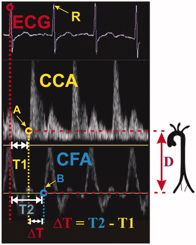 Figure 1. PWV determination: time diversity of electrocardiographic and Doppler signals. CCA, common carotid artery; CFA, common femoral artery; ΔT, transit time; D, carotid-femoral distance.
