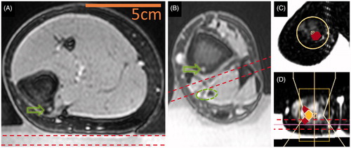 Figure 6. Estimation of near field heating and ensuring treatment safety. Bounds of an imaging slice (7 mm thick) dedicated to near field temperature monitoring are depicted using dashed lines. Green arrows indicate the location of OO nidus and a green dashed oval marks a neurovascular bundle that must be spared from ablation. (A) Positioning a slice dedicated to near field temperature monitoring may not be possible in the muscle and skin temperature may be approximated at the gel-skin interface (OO in tibia, Patient 7). (B) Near field monitoring slice may be placed between the targeted bone surface and a critical structure to ensure its safety (tibia, Patient 8). (C) Near field image through muscle and fat in the OO vicinity (phalanx, Patient 4). (D) Orthogonal T1-weighted images show that monitoring of near-field temperature in the phalanx. The HIFU beam is outlined along with areas of sub-lethal thermal effect (filled in red in C and D) and lethal thermal effect (white borders and yellow fill in D).
