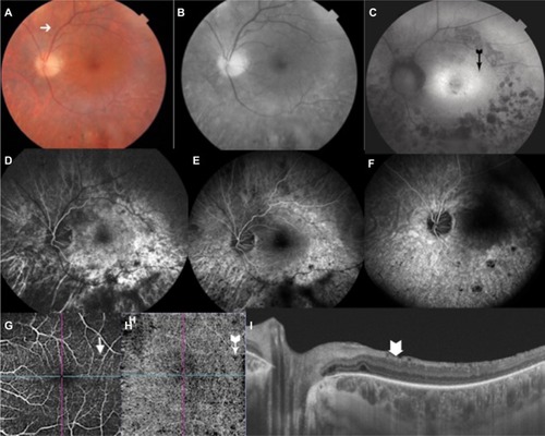 Figure 2 Multimodal images of the left eye.