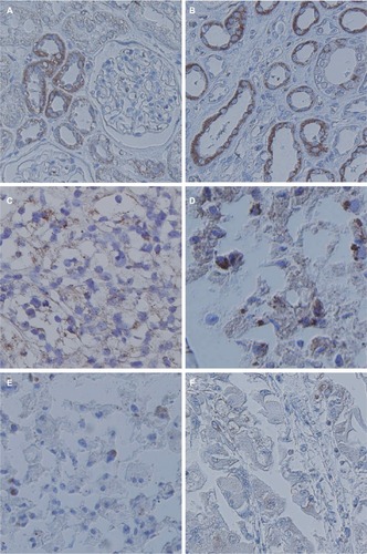 Figure 4 TRPV1 IHC staining in normal kidney tissue and RCC histopathological subtypes.Notes: (A, B) Staining was moderate to strong in the proximal tubule cytoplasm and weak to moderate in CDs and DTs, but glomeruli was negative for TRPV1. (C) Diffusely moderate immunoreactivity in clear cell RCC. (D) Focal weak to moderate immunoreactivity in granular RCCs. (E, F) Focal weak to poor staining in chromophobe RCCs and papillary RCCs could be detected. Hematoxylin counterstain, reduced from ×200.Abbreviations: CDs, collecting ducts; DTs, distal tubules; IHC, immunohistochemical; RCC, renal cell carcinoma; TRPV1, transient receptor potential vanilloid type-1.