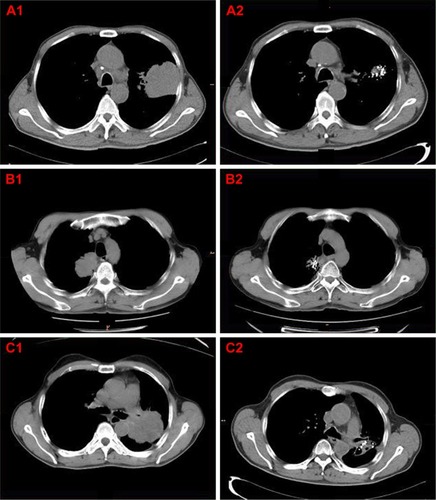 Figure 1 CT scan images of typical patients in group A.