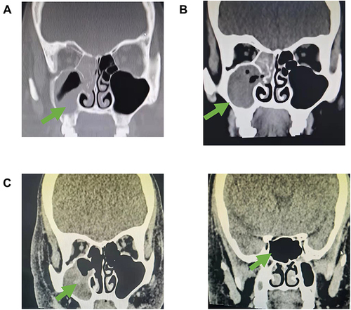 Figure 3 Imaging changes of patient 4. (A) Imaging results in D0 showed inflammation of the right maxillary sinus and sphenoid sinus, suggesting possible fungal infection. (B) The imaging results before surgical debridement (D5) indicated that the inflammation had progressed; (C) Imaging results after treatment (D16) suggest that inflammation is relieved. Arrows indicate the site of infection.