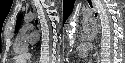 Figure 4 (A) A CBCT sagittal image showed a diffuse osteolytic lesion of the sternal body with cortical disruption. (B) A CBCT sagittal image showed a better deposition of cement in the lesion and a small amount of cement in front of the sternum.