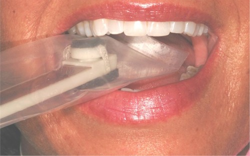 Figure 9 The pressure sensor is placed in the patient’s mouth in the site where the loading will occur and the patient is instructed to bite with maximum force.