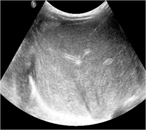 Figure 12 The last follow-up showed no significant liver abnormalities.