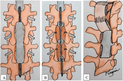 Figure 6. Schematic picture demonstrates surgical treatment modalities for non-communicating extradural arachnoid cyst; laminectomy (A), Recapping T saw laminoplasty (B), vascularized pedicled laminoplasty (C).