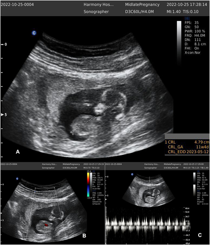Figure 3 Follow up scan a month later shows 11 weeks + 5 days intrauterine gestation (A) with positive fetal heart tone (B and C).