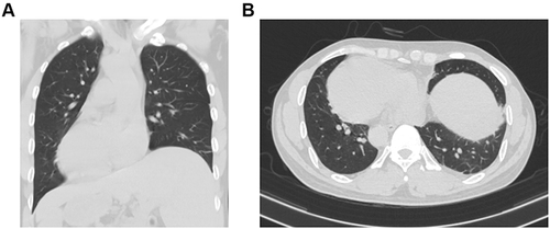 Figure 1 The coronal (A) and axial (B) view of chest contrast-enhanced computed tomography showing dextrocardia and SIT.