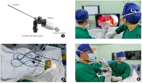 Figure 1. (1) Components of the wireless thoracoscope. (2) Lung surgery using wireless thoracoscope. (3) Wired thoracoscopic system with a messy operating table. (4) Wireless thoracoscope with a clean operating table.