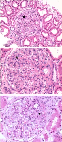 Figure 4 Class II lupus nephritis showing mesangial hypercellularity (asterisks).