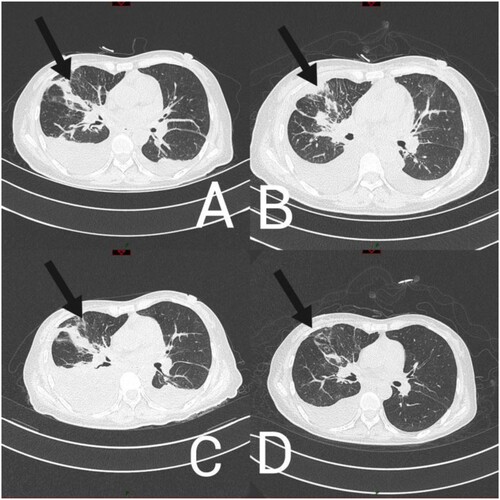 Figure 2. Chest computed tomography findings of a patient (A) 19, (B) 28, (C) 35, (D) 48 days after admission.