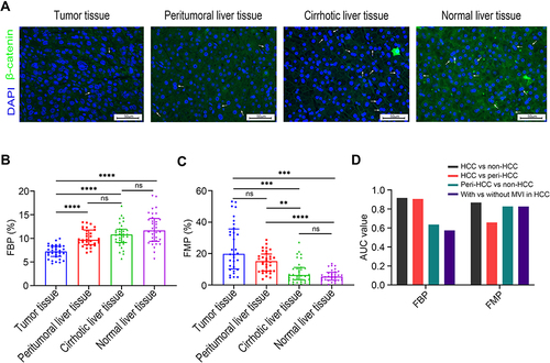 Figure 1 Ploidy distributions during liver tumorigenesis. (A) Representative immunofluorescence images in the observation set (original magnification: 400×, scale bar = 50 μm); β-catenin (green) was stained to label the plasma membrane, and DAPI (blue) for the nucleus labelling (white arrow indicates binuclear hepatocytes). Comparisons of FBP (B), and FMP (C) during hepatocarcinogenesis. Levels of significance: **p< 0.01, ***p< 0.001, ****p< 0.0001, ns, not significant (Dunn’s multiple comparisons test). (D) Discriminative capacities of FBP and FMP as the classification signal. The FMP exhibited higher AUC values than the FBP as a diagnostic maker to distinguish peritumoral liver tissues from non-HCC tissues and to detect the presence of MVI in HCC tissues.