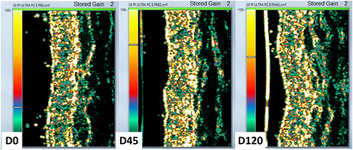 Figure 6 Ultrasonographic images from one participant disclosing the most expressive increasing in the dermal thickness from D0 (540 µm) to D45 (895 µm), and D120 (1633 µm), at the point C (laterally to the sternocleidomastoid muscle).