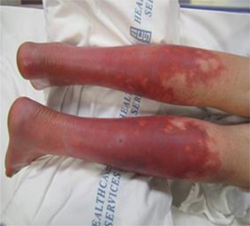 Figure 5 Photograph of the lower extremities of patient 3 with primary EM, demonstrating erythema and discoloration.