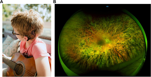 Figure 1 Child with profound sensorineural hearing impairment due to Usher syndrome using a cochlear implant to access sound (A) and image of another adult Usher patient’s retina, showing degeneration from retinitis pigmentosa (B). Image A courtesy of K. Disher-Quill, Image B courtesy of the VENTURE IRD registry, Centre for Eye Research Australia and the University of Melbourne.Citation4