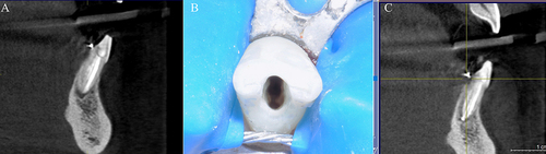 Figure 7 RCRt case of a central lower incisor characterized by three different orifices and three canals with a single port of exit.