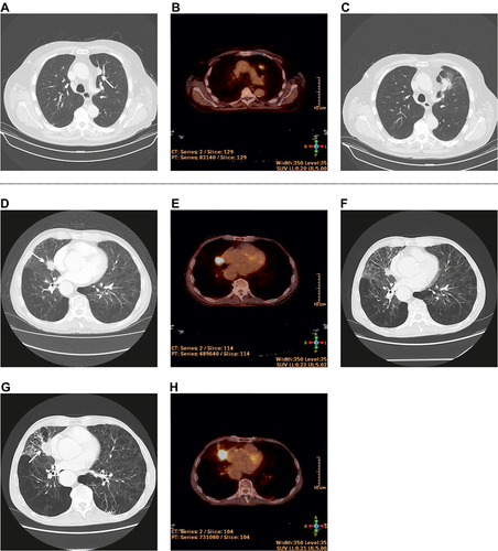 Figure 10 SUVmax persistence associated with local recurrence. (A–C): (A) A 79-year-old patient had a tumour-related finding on a CT (size 18 mm, white arrow). (B) The patient refused histological confirmation and a PET was performed. SUVmax was 7.56. (C) 2 months after SBRT (7.5 Gy in 7 fractions, total dose 52.5 Gy), the size increased (27 mm), and SUVmax raised to 8.01 (images not shown). Tumour progression was histologically confirmed, but the patient refused salvage treatment. (D–H): (D and E) 75-year-old patient with histologically confirmed non-small cell lung cancer. CT (size 24 mm, white arrow) and PET/CT (SUVmax = 13.75) at the time of diagnosis. The patient had a severe COPD resp. emphysema. SBRT was done with a dose of 5 Gy in 10 fractions (total dose 50.0 Gy). (F) Tumour response (size 17 mm), no evidence of RP. (G) 6 months after SBRT, new tumour growth (30 mm, white arrow) was detected and histologically confirmed. (H) PET/CT for treatment planning was done (SUVmax = 18.31). SUVmax failed to decline. Salvage-treatment was done.