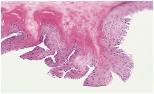 Figure 3. Subungual layered hyperkeratosis with fibrin and foci of micro hemorrhage (H&E × 200).