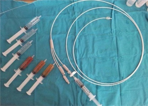 Figure 1 Triple lumen balloon catheter and components of locally prepared fibrin glue.