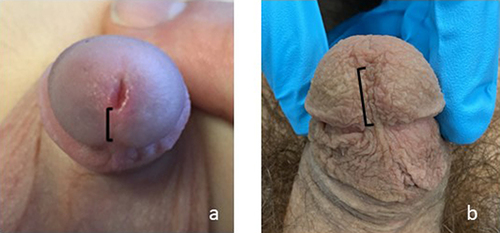 Figure 1 Normal glans fusion in a prepubertal patient (a) and a circumcised adult (b). The bracket indicates the distance from the lower lip of the meatus to the corona.