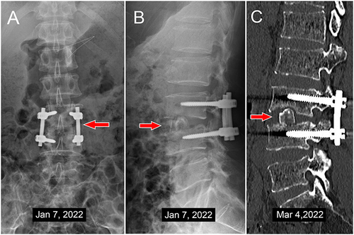 Figure 7 The follow-up X-ray and CT images.