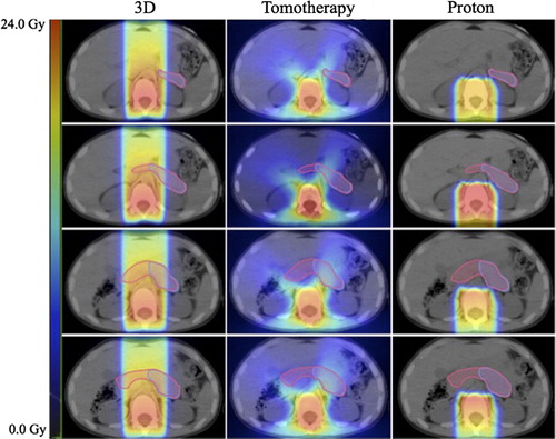 Figure 2. Dosimetric comparison of modalities: cranio-spinal irradiation for medulloblastoma. Left to right: 3D conformal radiotherapy, tomotherapy, proton therapy. Contoured structures: pancreas (pink), pancreatic tail (violet). Scale bar: 0–24 Gy.