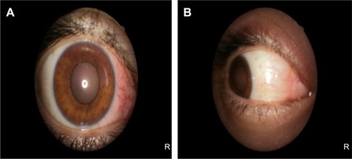 Figure 1 Represents the color photo of the right eye at pre-treatment and post-treatment phases.