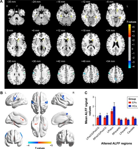 Figure 1 Spontaneous brain activity in the EPs versus HCs.