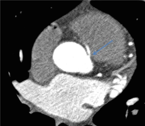 Figure 3 CCTA showing a slit like opening with 50% stenosis of the anomalous RCA from the left coronary cusp.